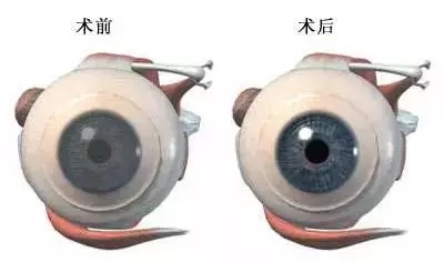 一眼萬年幾度輪回:華德眼科角膜移植全攻略