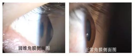 角膜膠原交聯術早期圓錐角膜