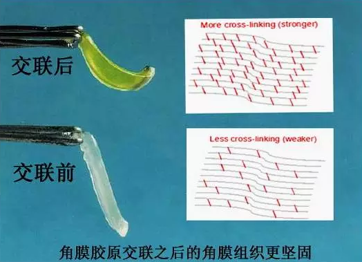 角膜膠原交聯術早期圓錐角膜