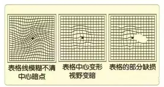 眼底病會引起的6大危害，看圖自測眼底病。