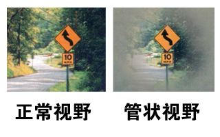 當青光眼遇上白內障，這場防盲保衛戰該怎么打？