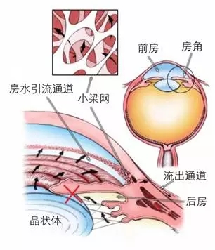 當青光眼遇上白內障，這場防盲保衛戰該怎么打？
