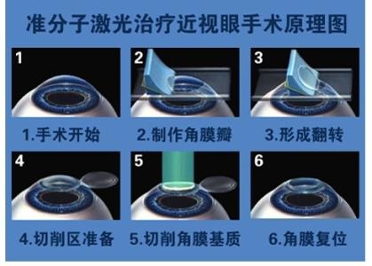 準(zhǔn)分子手術(shù)臨床技術(shù)操作規(guī)范