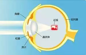 【ICL人工晶體植入術(shù)】跟高度近視眼如何“接軌”？
