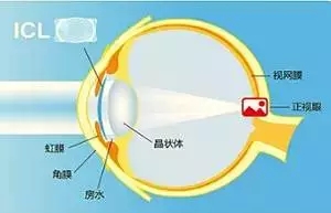 【ICL人工晶體植入術(shù)】跟高度近視眼如何“接軌”？