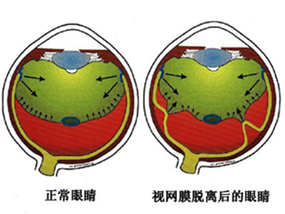 視疲勞可導致視網膜脫落？！