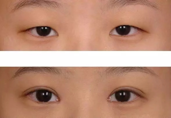 上瞼下垂矯正術解析