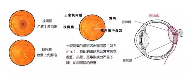 老年性黃斑變性，從年輕時(shí)就要開始防護(hù)