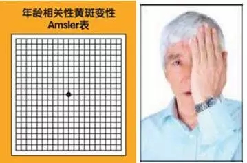 老年性黃斑變性，從年輕時(shí)就要開始防護(hù)
