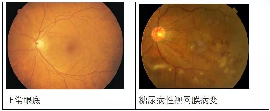 患了“糖尿病”后，該做哪些眼科檢查？