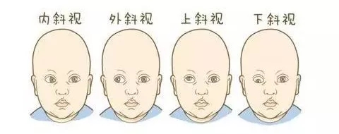 孩子斜視弱視不及時，導致毀一生？專家告訴您真相！