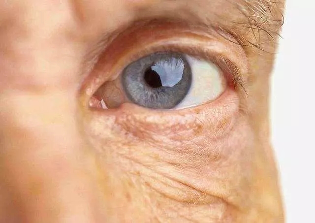 黃斑變性或致致盲：50歲以上人群每年都應(yīng)檢查