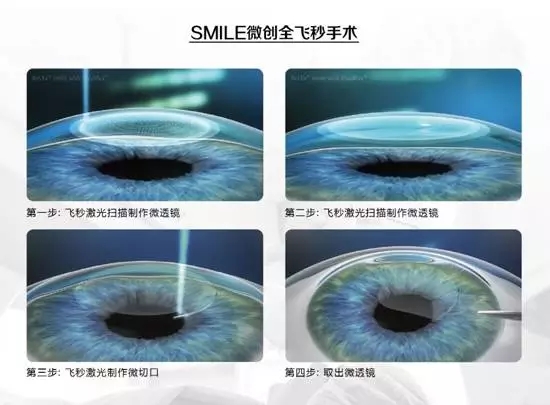 近視手術已經進入“綠色全飛秒時代”