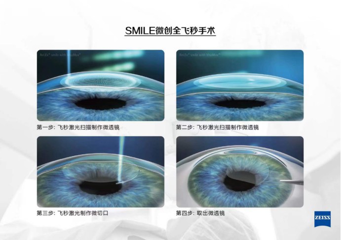普瑞華德眼科暑期摘鏡總動員之全飛秒不有效攻略