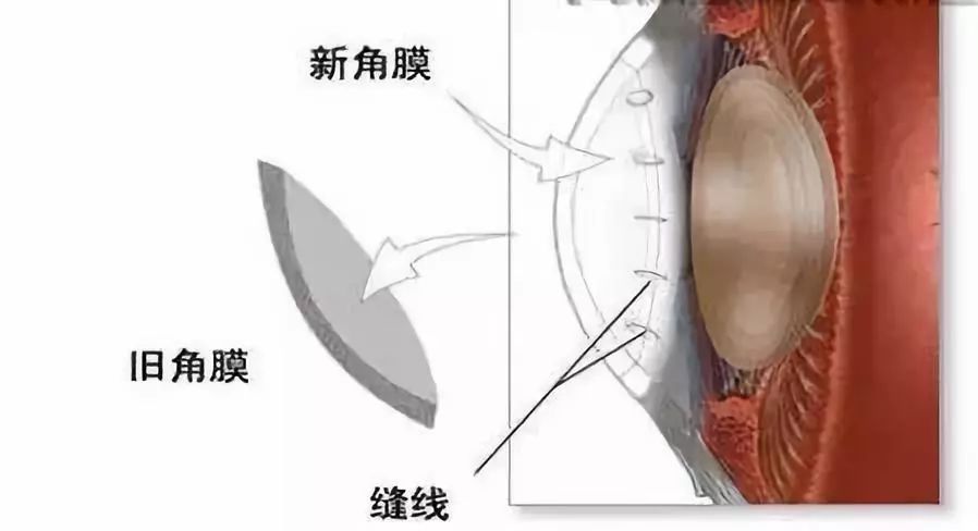 哪些眼病需要做角膜移植手術？